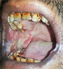 Oral Submucous Fibrosis OSMF care at Apex Dental Care Bhadrak